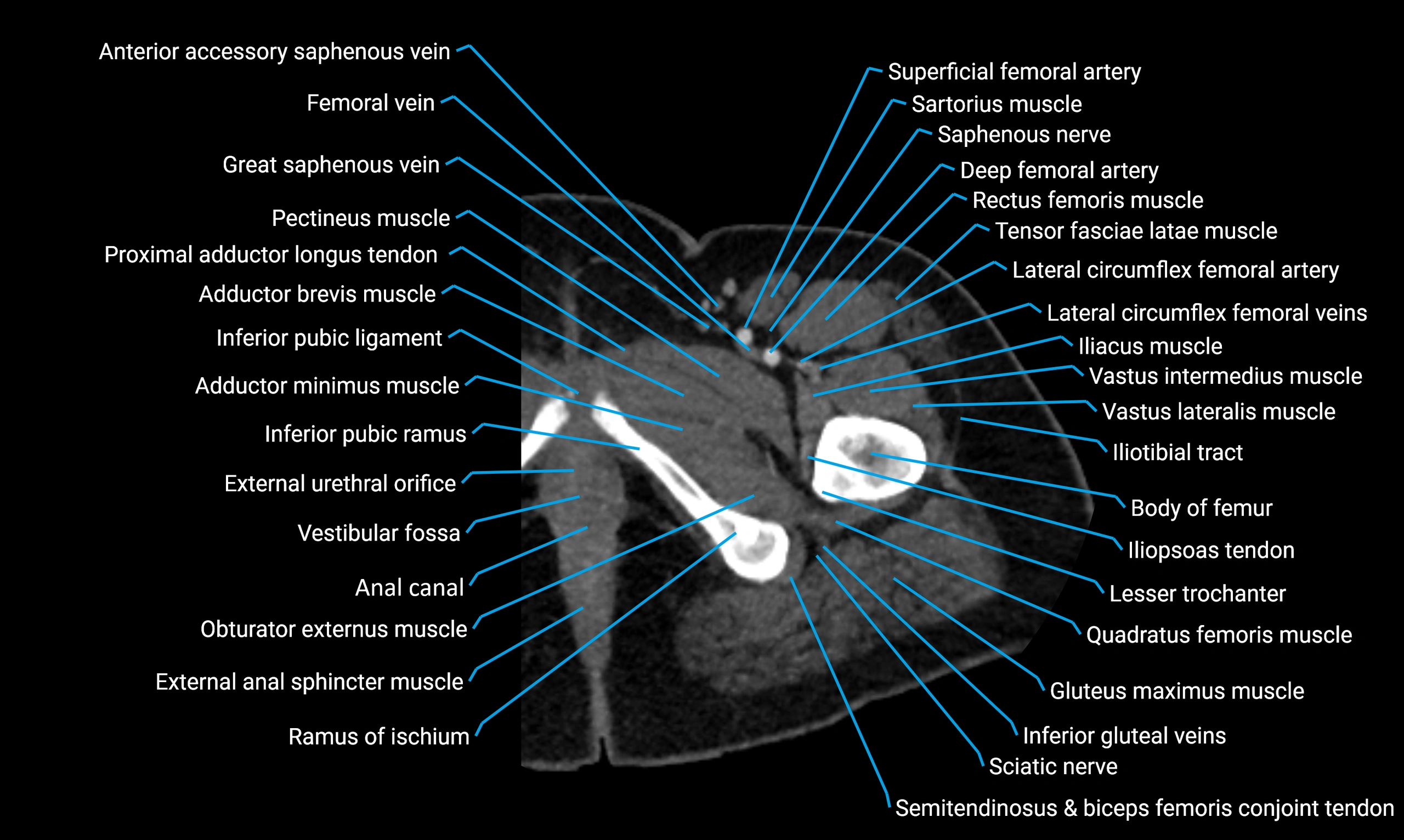 CT lower limb axial cross sectional anatomy labelled image 16 (2).webp